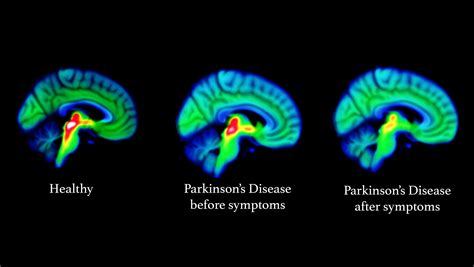 does a brain scan show parkinson's